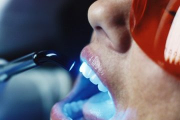 Dantų balinimas lazeriu – pliusai ir minusai